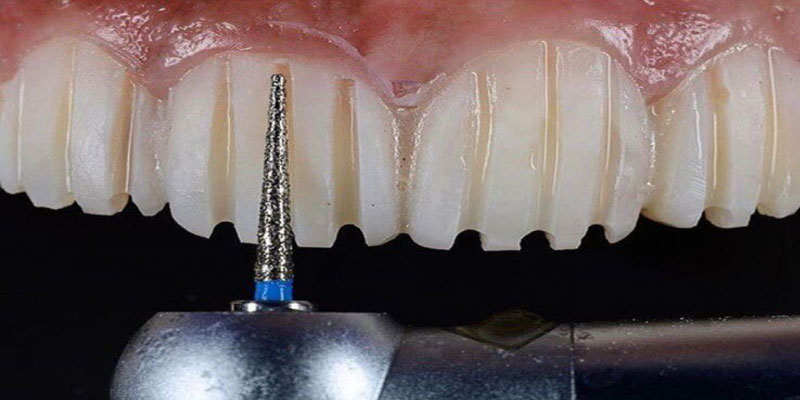 چه مقدار از دندان باید برای لمینت دندان تراشیده شود