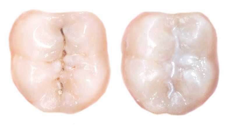 شیار پوش دندان یا فیشور سیلانت