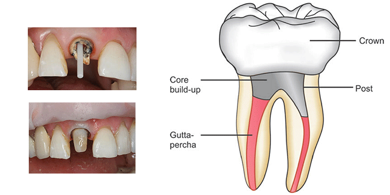 پست و کور دندان چیست