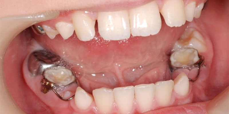 فضا نگهدار دندان در کودکان