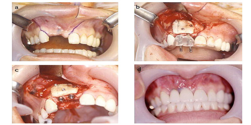 پیوند قطعه استخوان برای کاشت ایمپلنت دندان