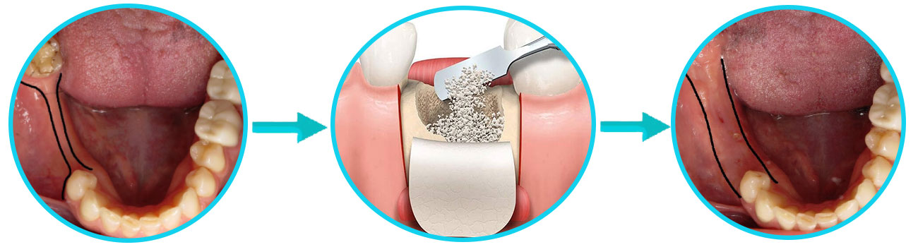 پیوند استخوان فک برای کاشت ایمپلنت دندان