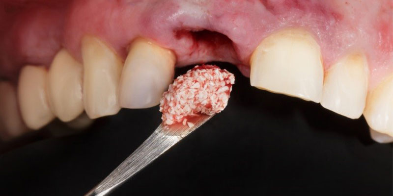 پیوند حفره دندان برای پیوند استخوان ایمپلنت