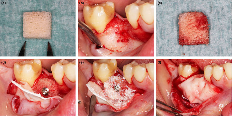 آیا پیوند استخوان دندانی برای کاشت ایمپلنت درد دارد