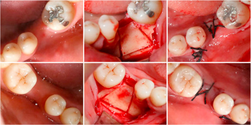 پیوند ستیغ فک برای کاشت ایمپلنت دندان