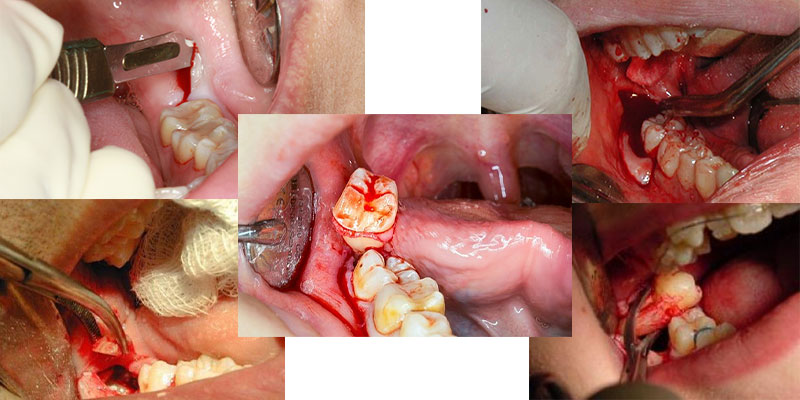 مراحل کشیدن دندان عقل