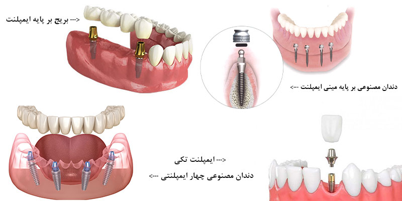 انواع پروتزهای دندانی بر پایه ایمپلنت