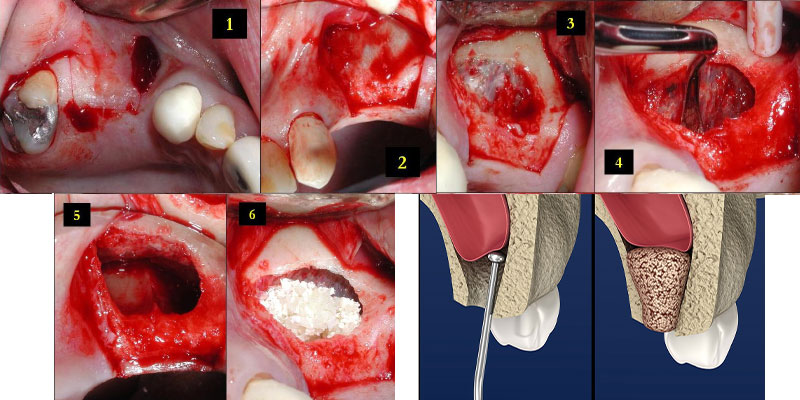 لیفت سینوس لثه برای کاشت ایمپلنت دندان
