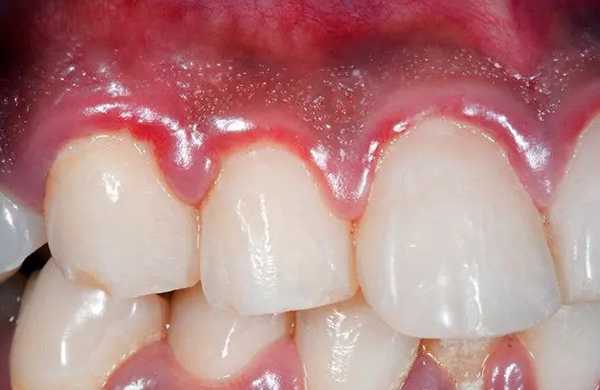 علت سیاه شدن لثه