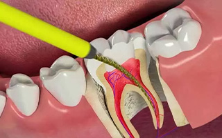 پالپوتومی (عصب کشی دندان شیری)