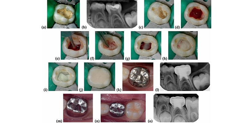 مراحل پالپوتومی دندان شیری