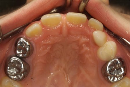 پالپوتومی دندان شیری