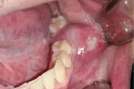 عکس کیست دندان