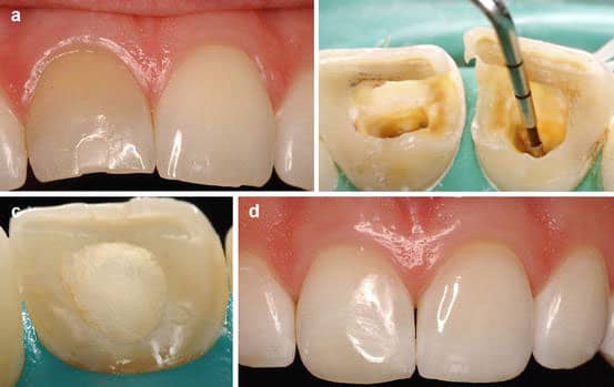 فرآیند سفید کردن داخلی دندان