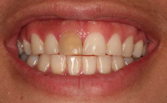 دلیل تغییر رنگ دندان ها بعد از عصب کشی 