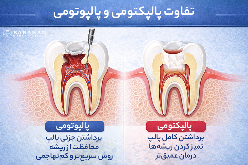 تفاوت پالپکتومی و پالپوتومی