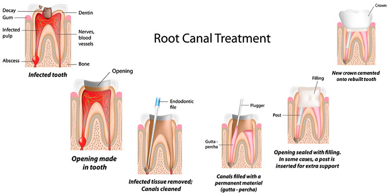 مراحل انجام عصب کشی دندان