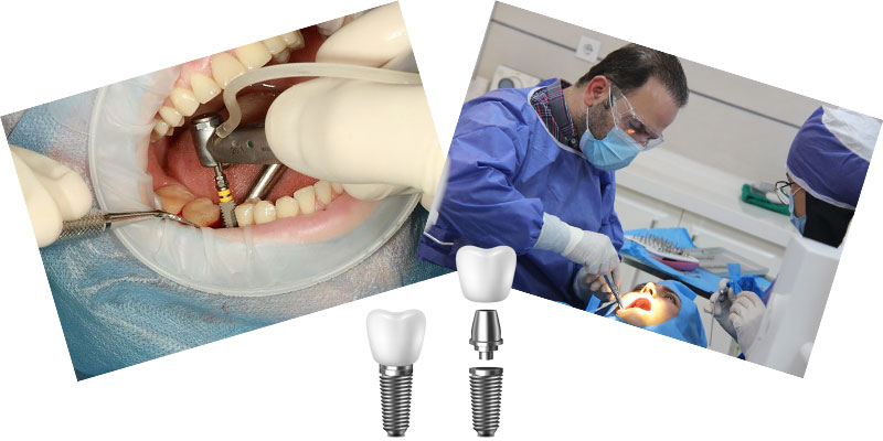 تفاوت متخصص ایمپلنت دندان و دندانپزشک