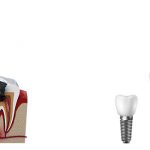 تفاوت متخصص ایمپلنت و دندانپزشک