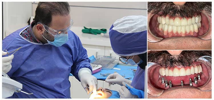متخصص ایمپلنت کیست و چه کاری انجام می دهد و تفاوت آن با دندانپزشک عمومی چیست