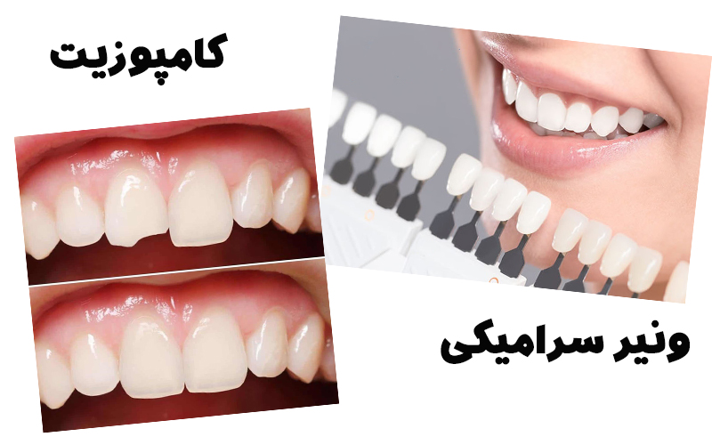 تفاوت کامپوزیت و لمینت
