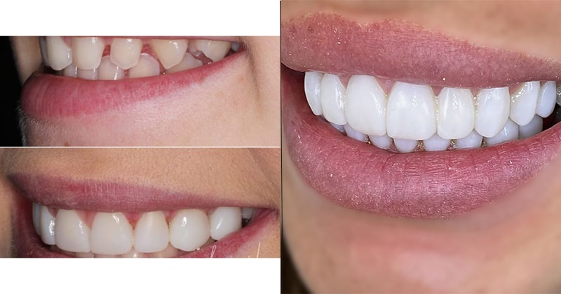 روش های افزایش ماندگاری کامپوزیت دندان