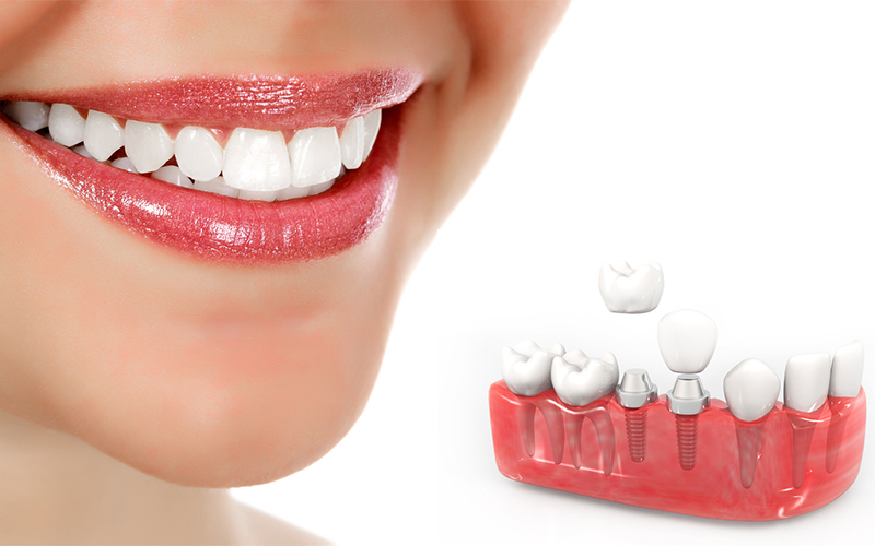 ایمپلنت دندان یکی از روش های اصلاح طرح لبخند