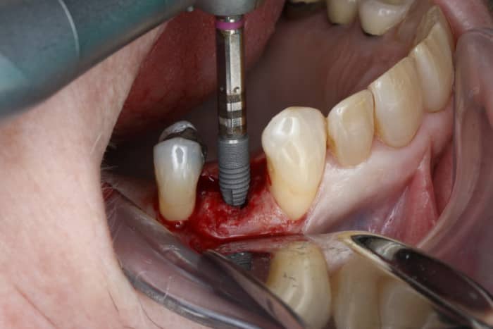 آیا در هر سنی میتوان ایمپلنت دندان کاشت