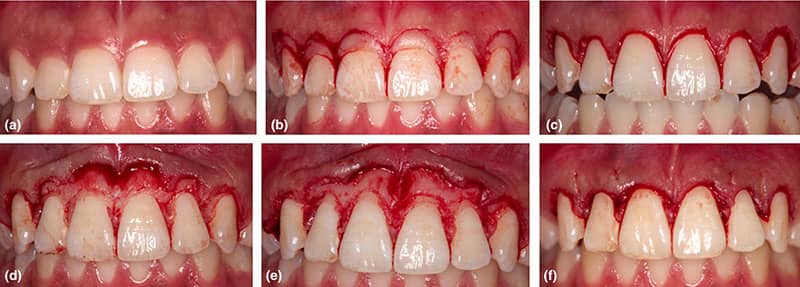 جراحی افزایش طول تاج دندان یکی از وظایف متخصص پریو