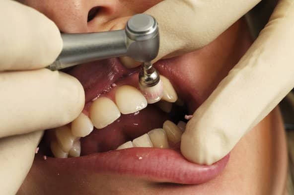جرمگیری و بروساژ دندان یکی از وظایف متخصص پریو