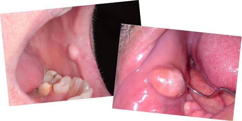 گاز گرفتن داخل دهان یا فیبروم تروماتیک دهانی چیست