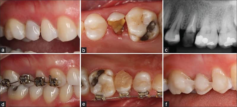 تأثیر ارتودنسی بر دندان عصب کشی شده