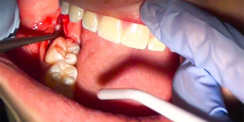 مراقبت های بعد از جراحی و کشیدن دندان