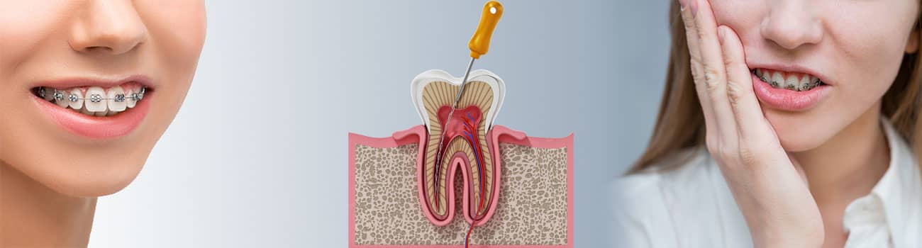 نحوه عصب کشی دندان درحین ارتودنسی