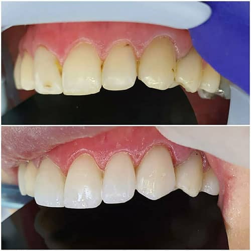 نمونه درمان بلیچینگ دندان در کلینیک بابکان