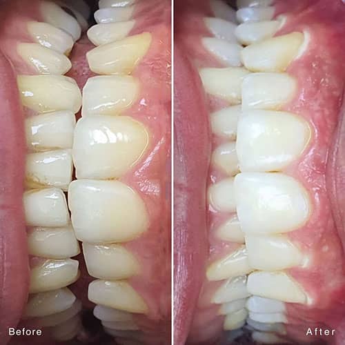 نمونه درمان بلیچینگ دندان در کلینیک بابکان در اندیشه
