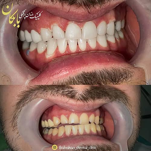 قبل و بعد از بلیچینگ دندان در درمانگاه بابکان در اندیشه