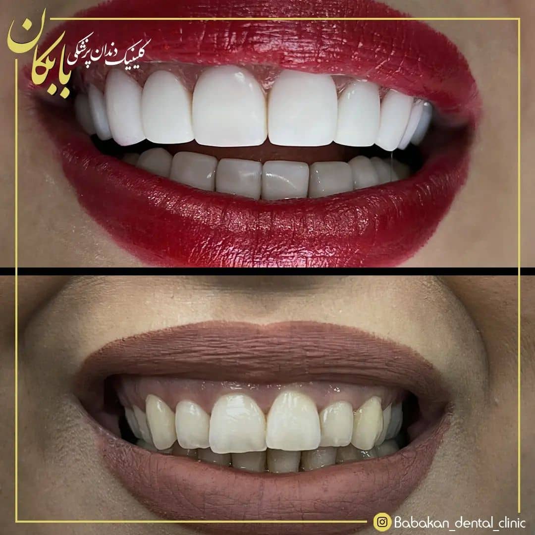 نمونه درمان کامپوزیت دندان توسط کلینیک بابکان