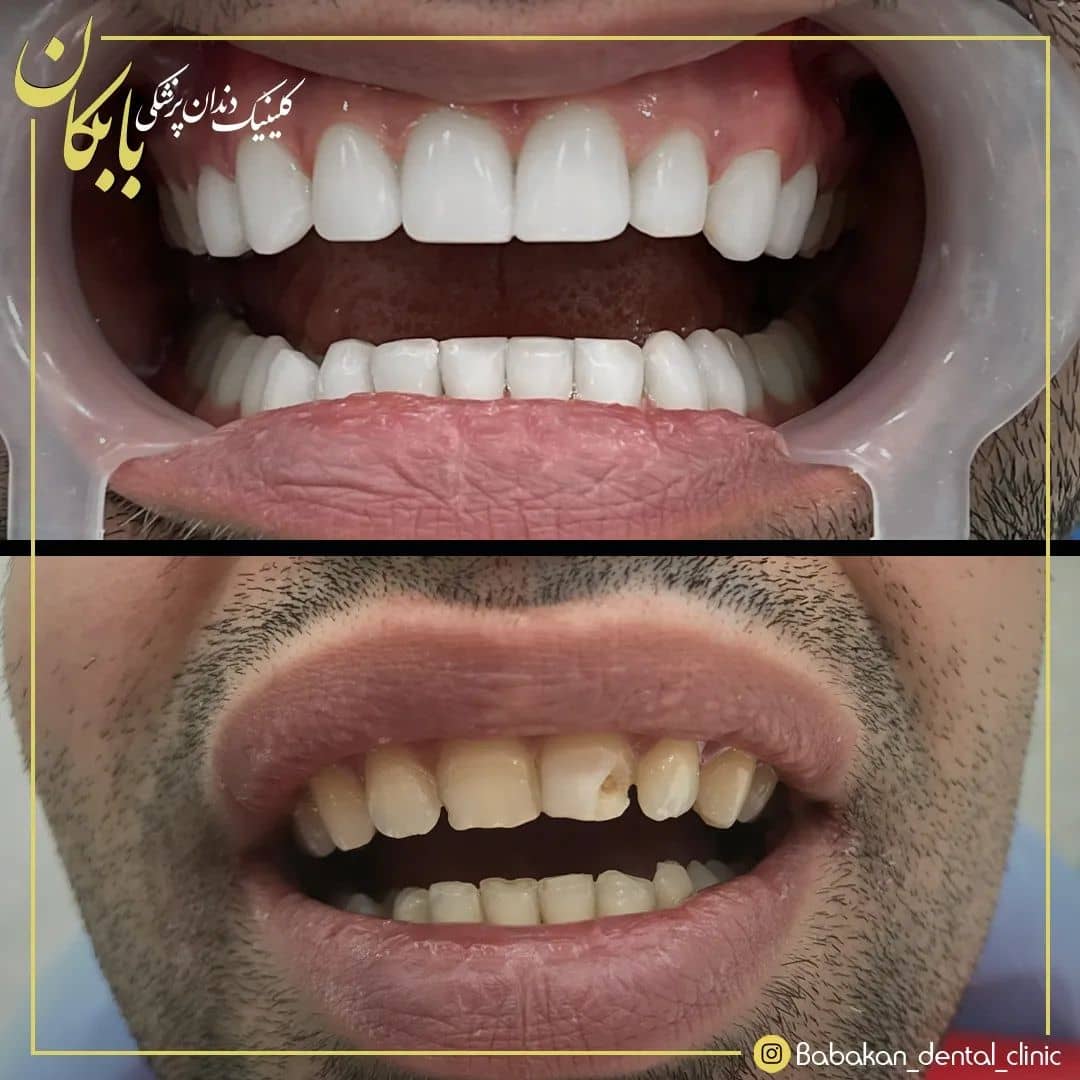 نمونه درمان کامپوزیت دندان توسط کلینیک بابکان