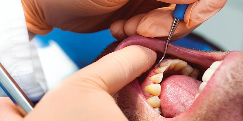 شرایط لثه و دهان بعد از کشیدن و جراحی دندان