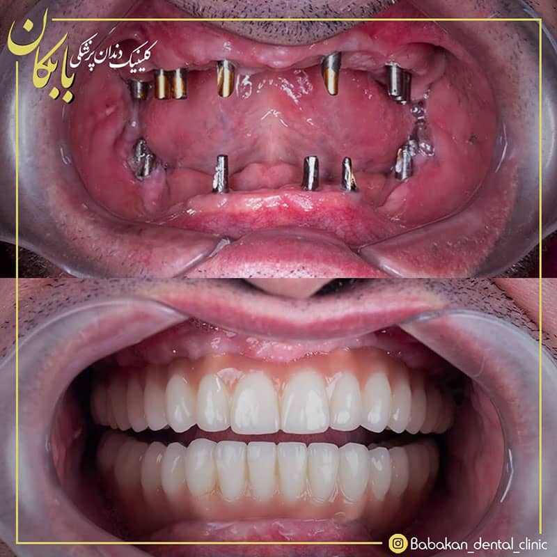نمونه درمان ایمپلنت دندان