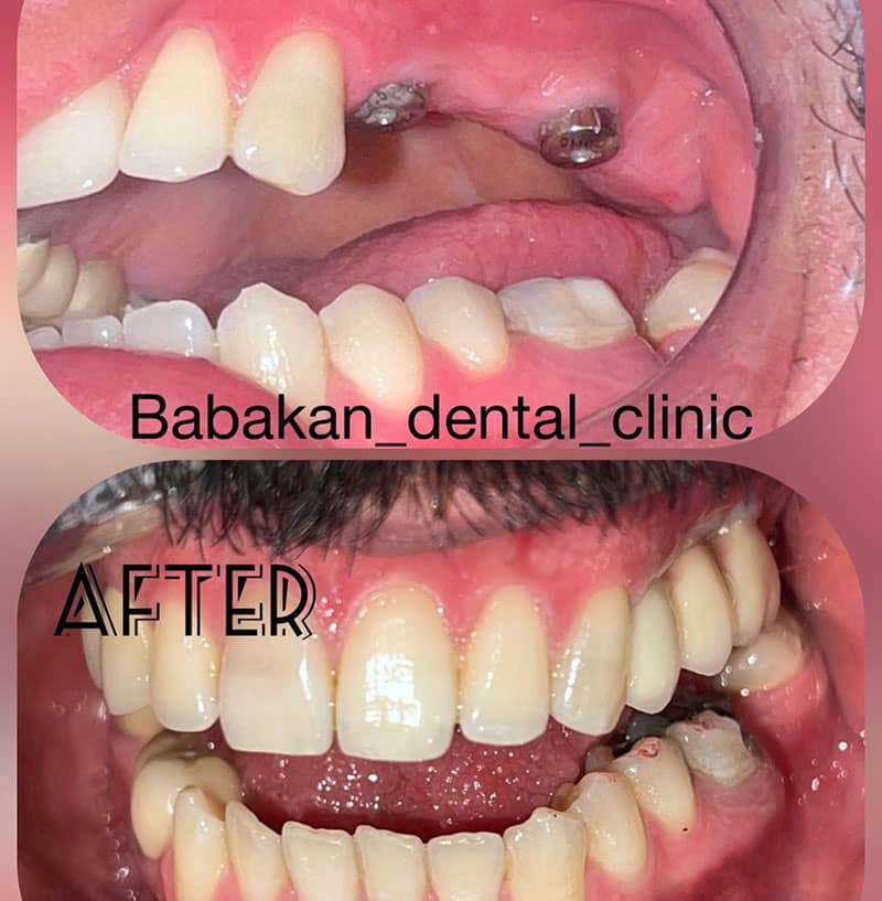 قبل و بعد از کاشت ایمپلنت دندان