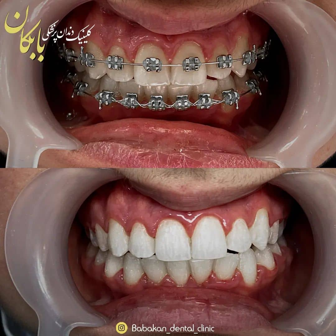 نمونه درمان ارتودنسی دندان توسط کلینیک بابکان