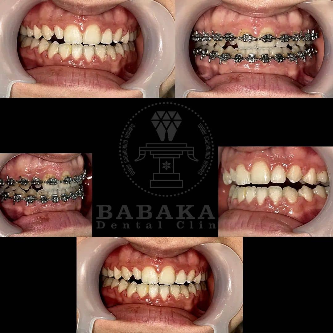 نمونه درمان ارتودنسی دندان توسط درمانگاه بابکان شهریار