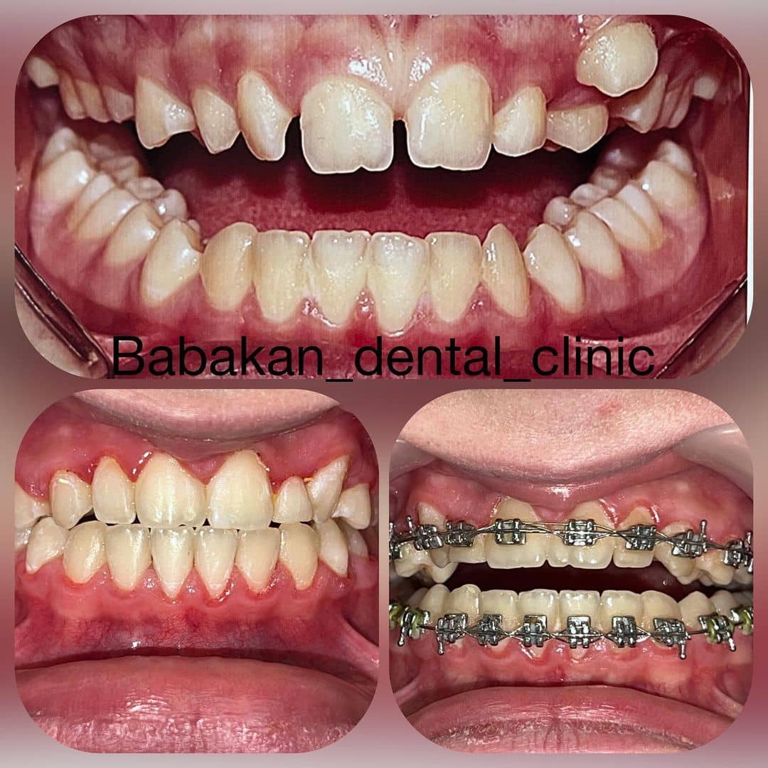 نمونه درمان ارتودنسی دندان توسط کلینیک بابکان شهریار