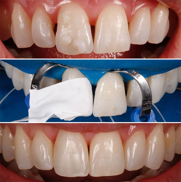 یکی از روش های سفیدکردن دندان ها با باندینگ کامپوزیت