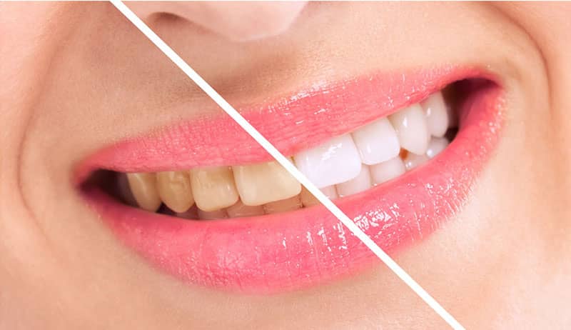 آیا امکان سفید کردن دندان های حساس وجود دارد؟