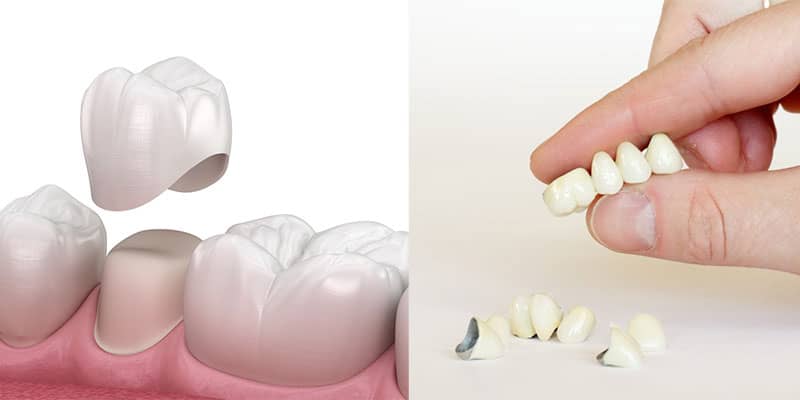 یکی از روش های سفیدکردن دندان ها با روکش دندان