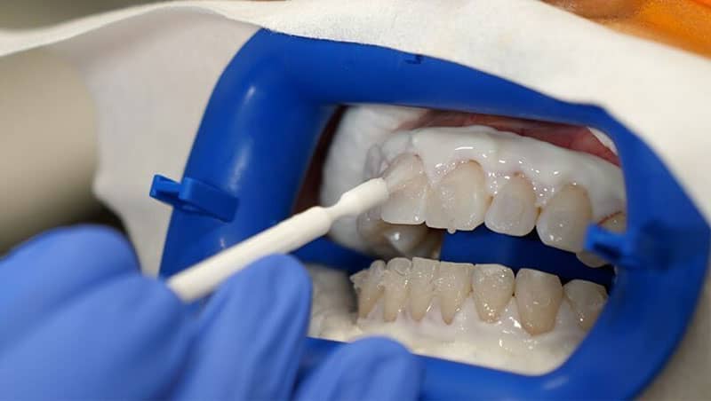 یکی از روش های سفیدکردن دندان ها با بلیچینگ