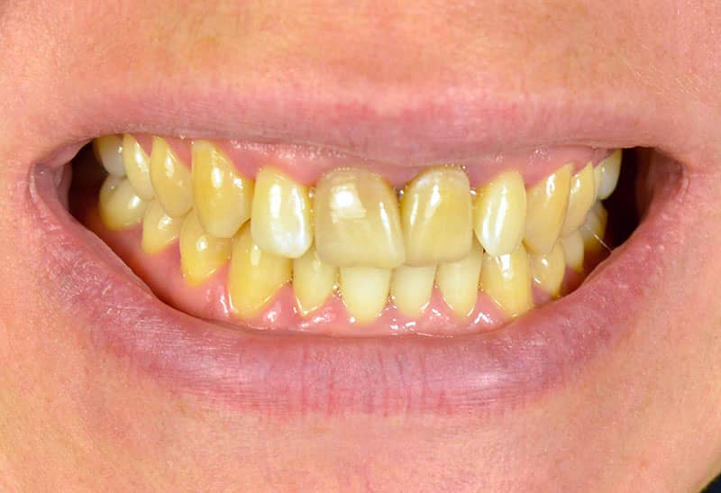 علت زرد شدن و روش های سفیدکردن دندان ها
